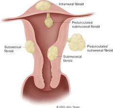 fibroids1